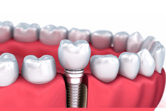 Dental Implants | Bedir Family Dental