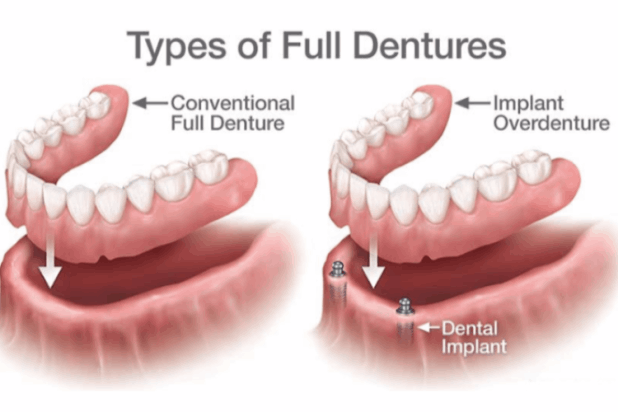 Dentures and implants