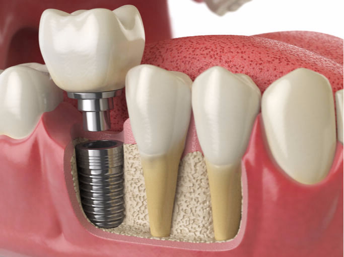 Bedir Dental Implants