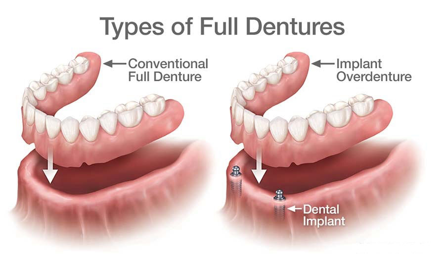 Dental-Implant-Dentures